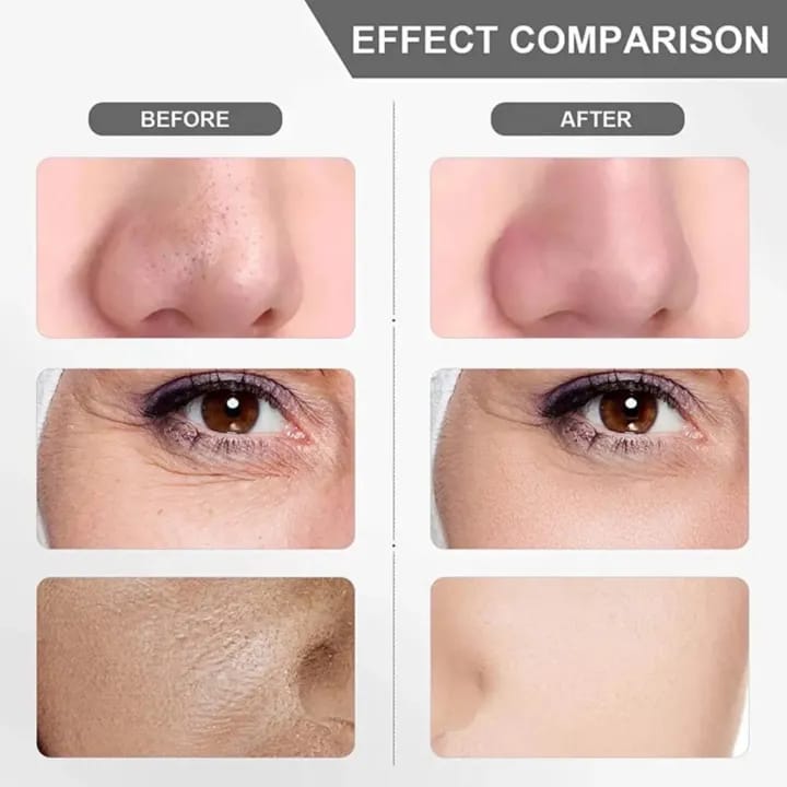 Electric Blackhead Remover Machine – Skin Care Tool
